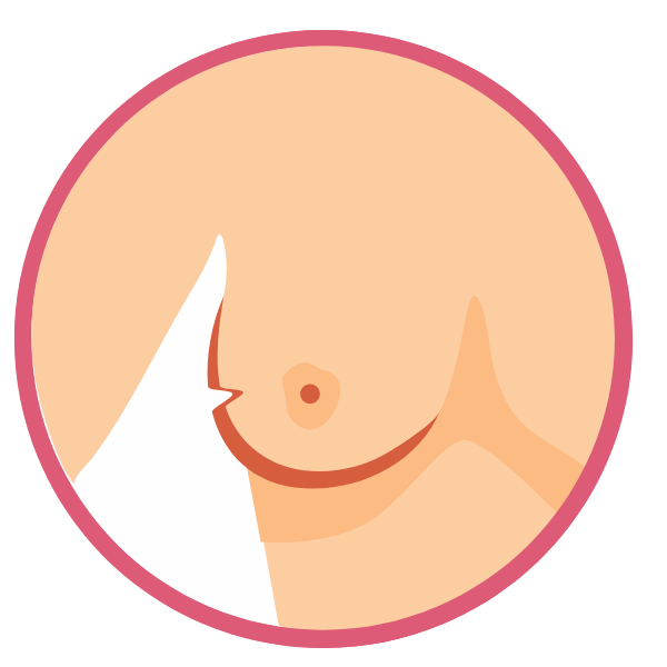 Skin dimpling or puckering